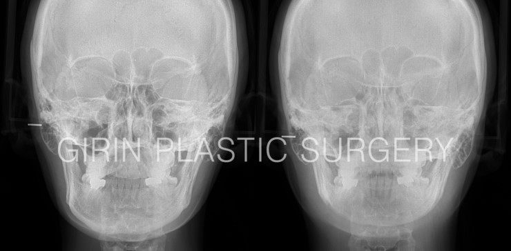 비대칭교정, 긴턱교정 22일경과 관련 이미지 6