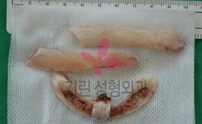 안면윤곽 후 절골된 bone 관련 이미지 1