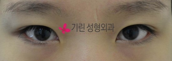 안검하수 (수술 후 6주 눈감은 사진) 관련 이미지 3