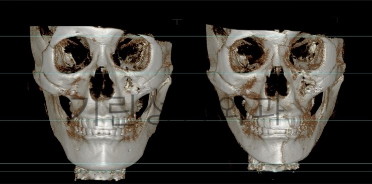 사각턱재수술 길이줄임 7일경과사진 관련 이미지 2