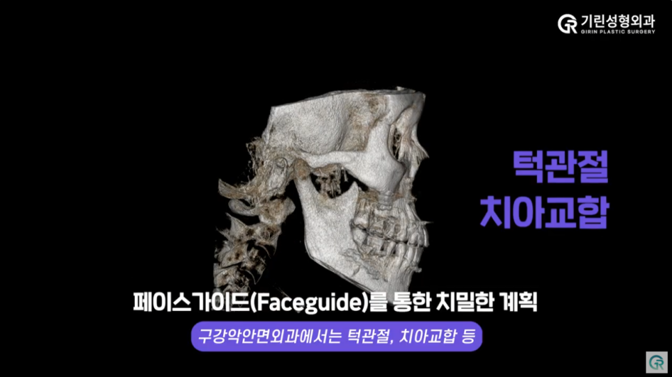 [기린성형외과의원] 턱관절장애 안면비대칭 미용목적 양악수술_구강악안면외과 전문의 관련 이미지 12