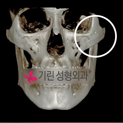 옆광대축소 전후CT 관련 이미지 1