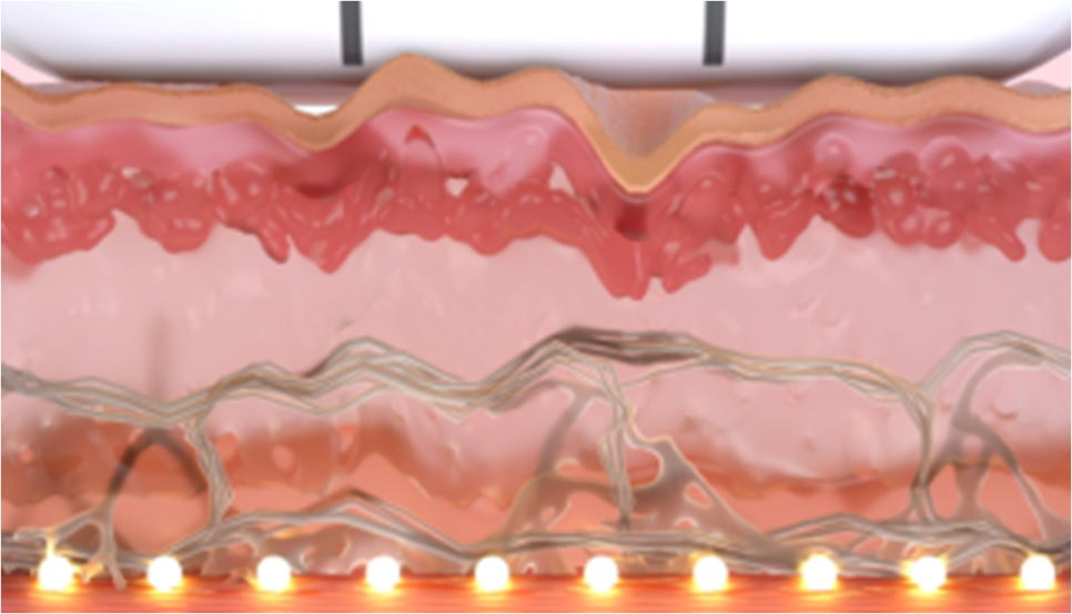 내 피부에 꼭 맞는 리프팅, 퍼스널울쎄라 관련 이미지 2