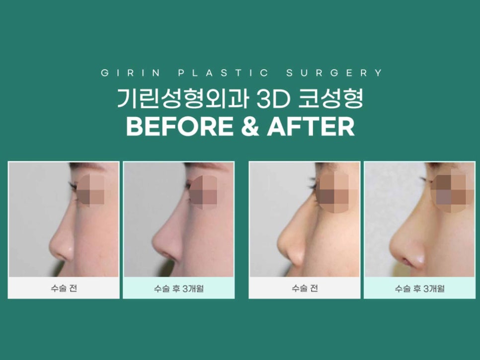 강남역성형외과유명한곳 얼굴에 맞춰 조화롭게 관련 이미지 5