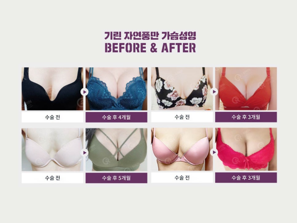 논현역 성형외과 안심할 수 있는 가슴확대수술 관련 이미지 2