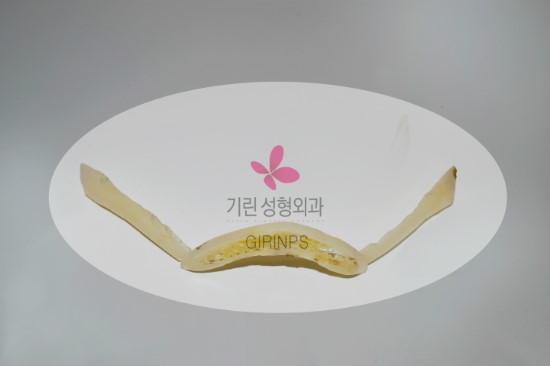 턱끝은 긴턱줄임수술 : 실제 뼈모양( 제거된 뼈가 있던 위치) 관련 이미지 2