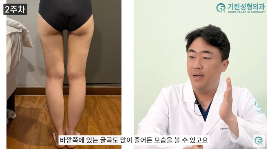 [기린성형외과의원] 뼈벅지?허틈!_허벅지지방흡입 수술일지 관련 이미지 9