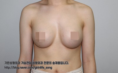 [가슴확대성형] 75A에서 75C로, 모티바 보형물을 이용한 가슴 확대 수술 케이스 관련 이미지 11