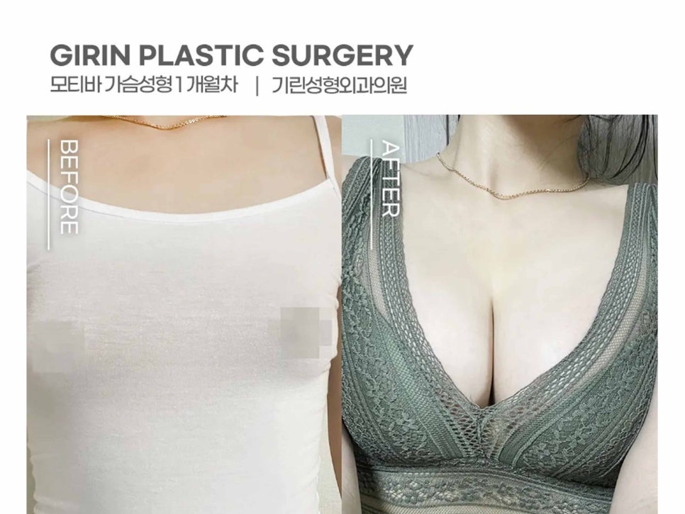 서울가슴성형 볼륨감 차이를 위해 관련 이미지 2