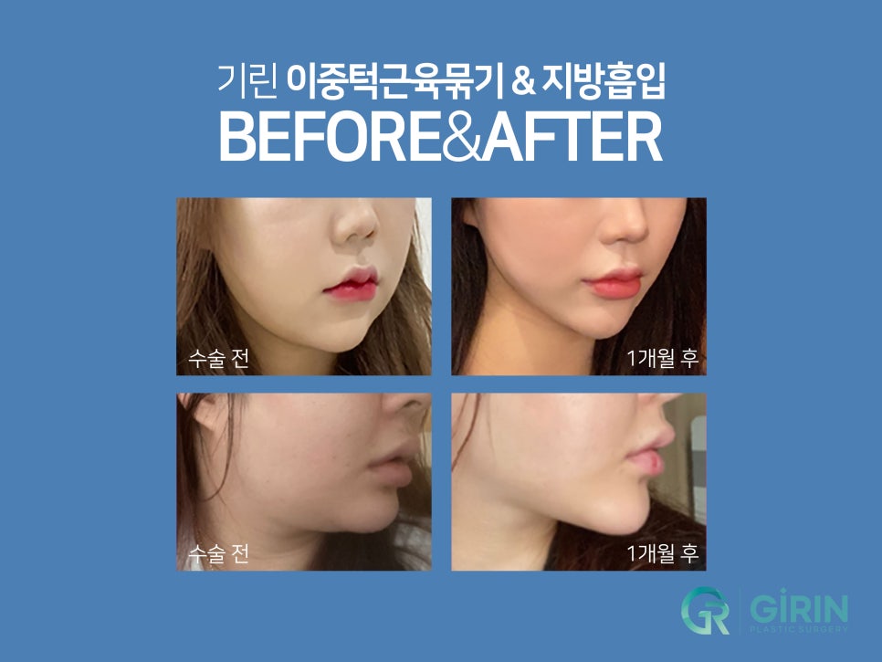 이중턱근육묶기 탄력 저하 잡아주는 관련 이미지 1