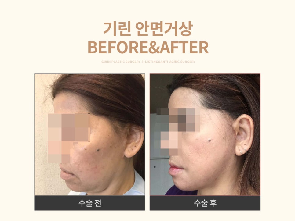 안면거상술잘하는병원 자세히 알아본다면 관련 이미지 1