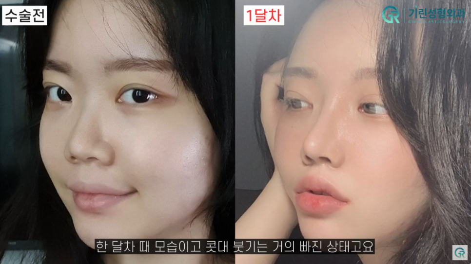 [기린성형외과의원] 코성형 전 코필러 하셨나요?_작은 코성형 수술일지 관련 이미지 6