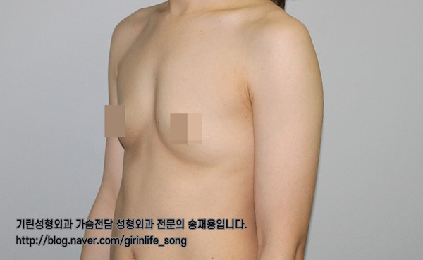 [가슴확대성형] 75A에서 75C로, 모티바 보형물을 이용한 가슴 확대 수술 케이스 관련 이미지 3