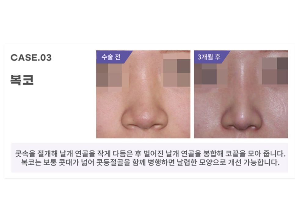 콧볼축소술 세련된 인상을 원한다면 관련 이미지 8