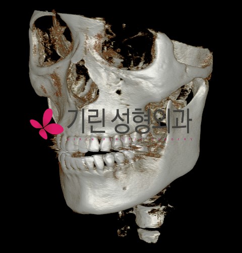 긴곡선 후 측면효과 관련 이미지 1