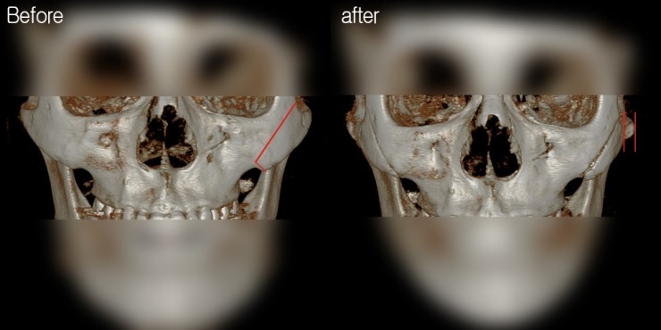 광대 부분절골- 광대비고정사례 관련 이미지 2