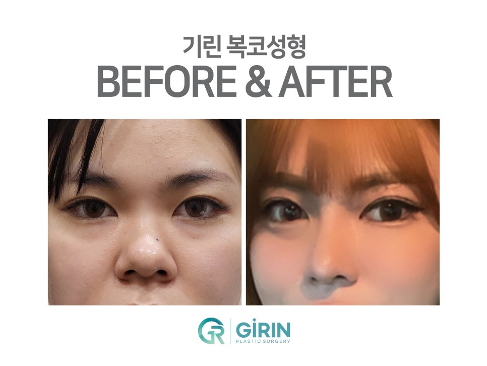 콧볼축소수술후기 주의한 점은 관련 이미지 7