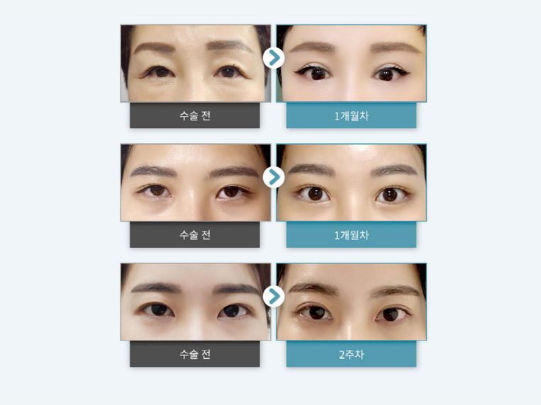 이마거상수술 주름을 개선하는 관련 이미지 10