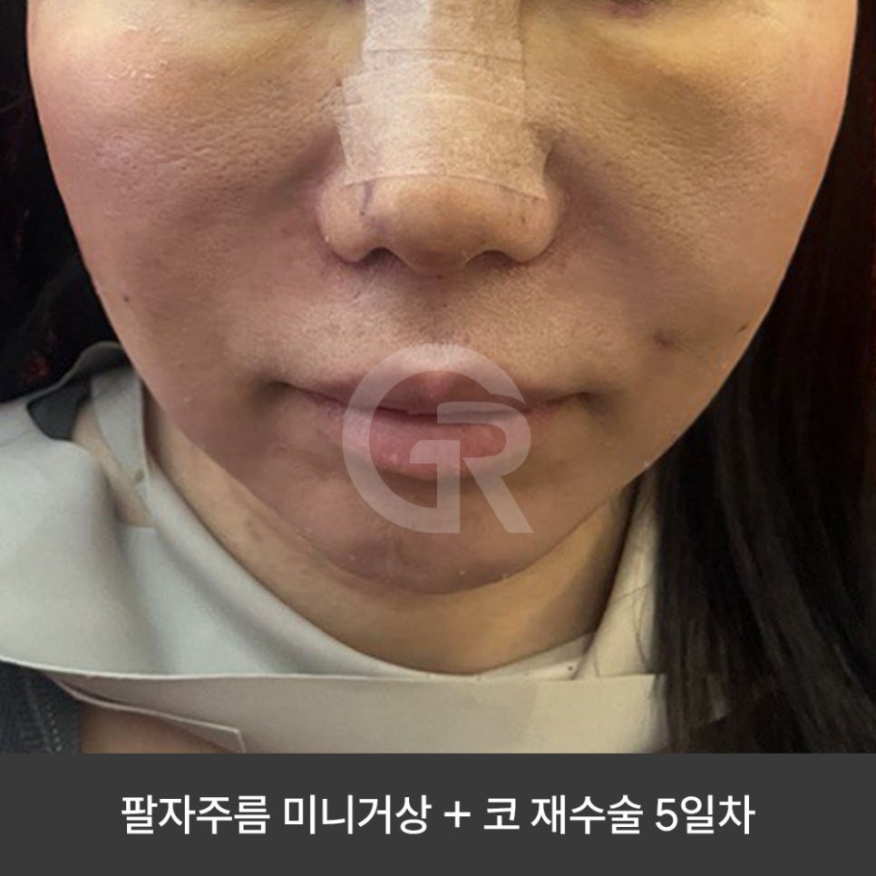 깊은 팔자주름 때문에 미니거상을 진행한 케이스(+코재수술) 관련 이미지 5