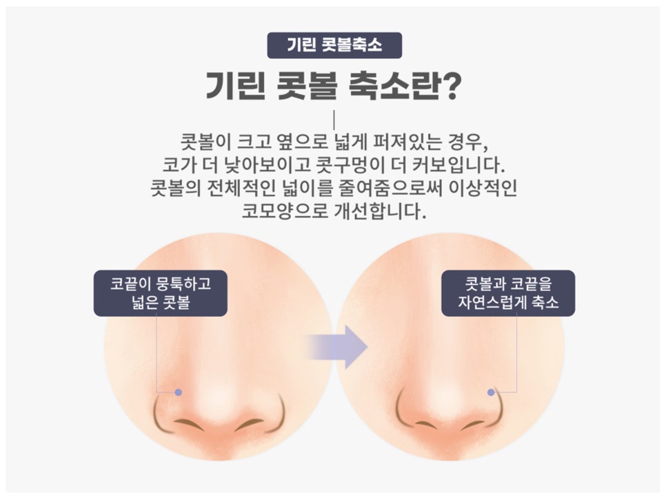 콧볼축소술 세련된 인상을 원한다면 관련 이미지 3