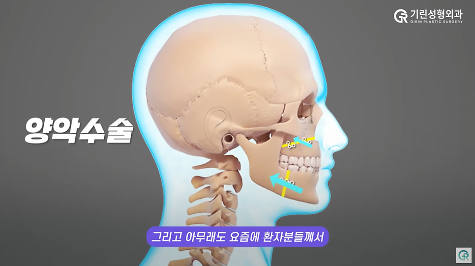 [기린성형외과의원] 턱관절장애 안면비대칭 미용목적 양악수술_구강악안면외과 전문의 관련 이미지 4