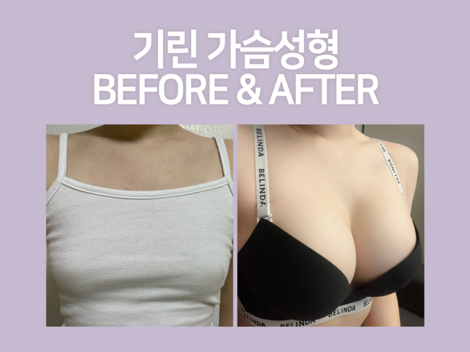 모티바가슴성형후기 신중하게 살펴보고 관련 이미지 8