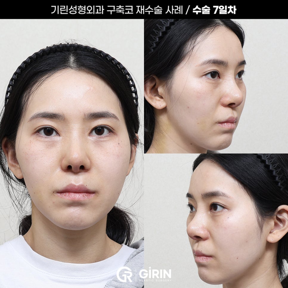 기린성형외과 코성형 구축코 재건 사례 관련 이미지 4