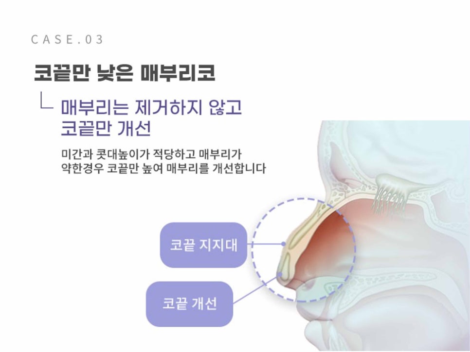 강남역성형외과유명한곳 얼굴에 맞춰 조화롭게 관련 이미지 12