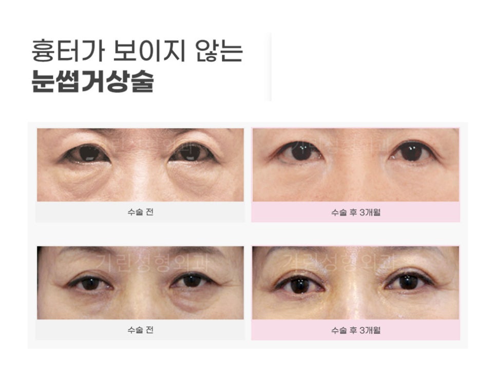 강남눈성형 눈가 주름 개선을 위해 관련 이미지 13