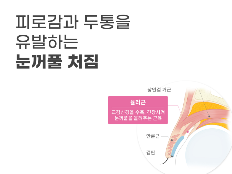 상하안검수술 인상을 바꾸기 위해 관련 이미지 8
