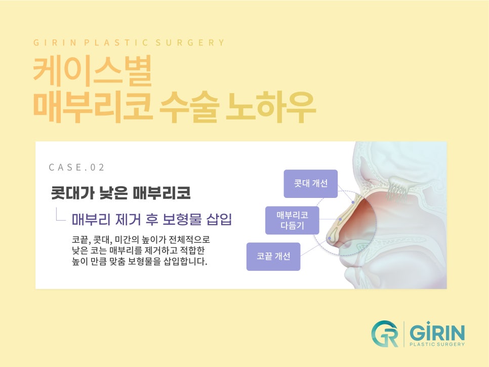 여자코성형 원하는 라인 고려하여 관련 이미지 8