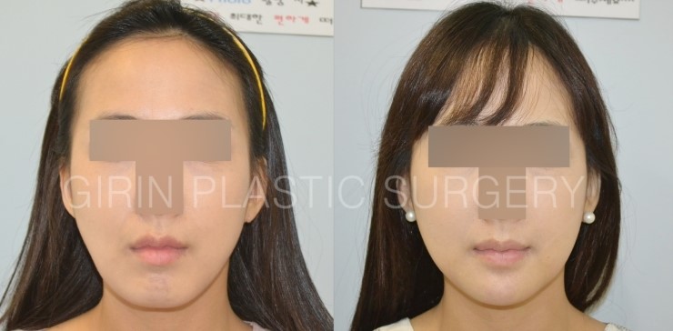 티절골재수술사례 관련 이미지 4