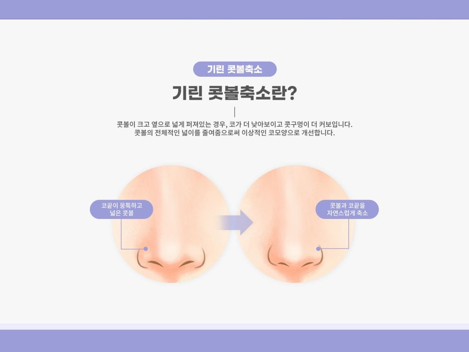비절개콧볼축소수술 자연스럽고 예쁜 코 만들기 관련 이미지 2
