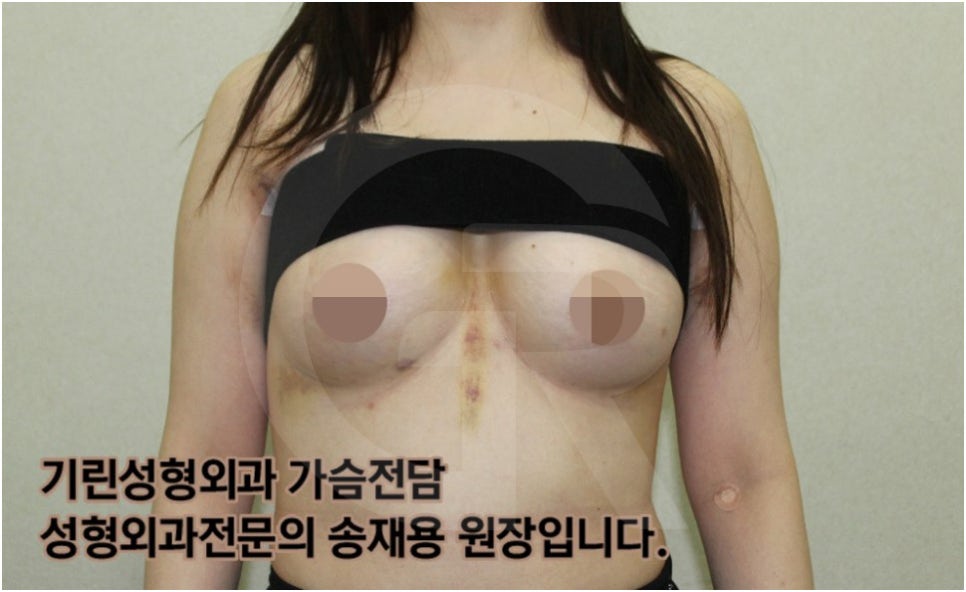 가슴확대수술 후 관리방법, 실제사례 알아보다. [기린성형외과의원_Dr.송재용] 관련 이미지 5