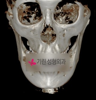 안면윤곽수술의 대표적인 사각턱과 앞턱(엑스레이사진) 관련 이미지 3