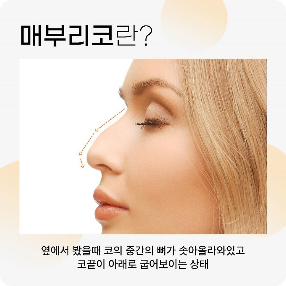 매부리코수술? 콧대만 깎는다고 해결 될까? 관련 이미지 1