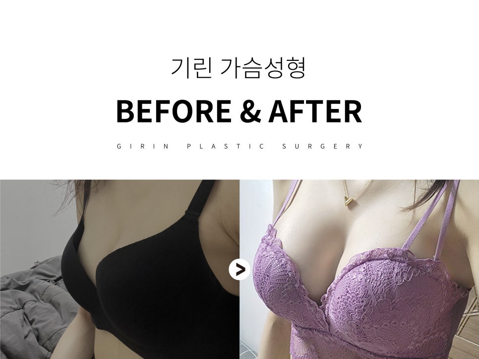 가슴성형잘하는곳 신중하게 보고 관련 이미지 1