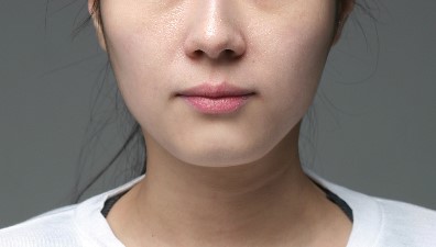 티절골만이 턱끝수술의 답일까? 관련 이미지 2