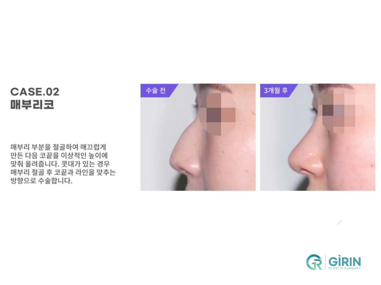 무보형물 코성형 안전하게 잘하는 곳 관련 이미지 8