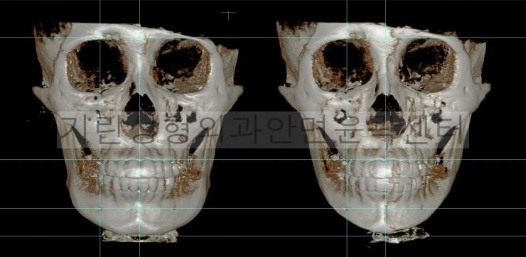 넓은턱수술+아큐스컬프+귀족 1달차 관련 이미지 3
