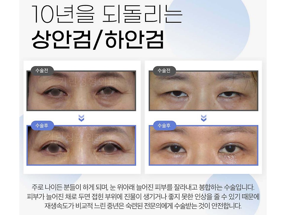 상안검하안검수술 빠른 회복을 위해 관련 이미지 1