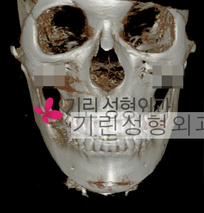 귀뒤사각턱수술 후 부작용: 효과없는 경우 관련 이미지 5