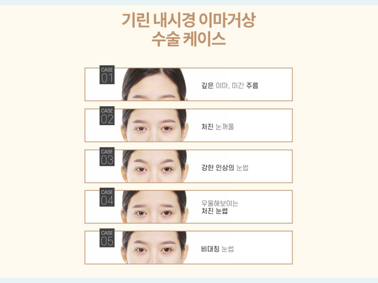 내시경이마거상 탄력 고민을 해결하는 관련 이미지 9