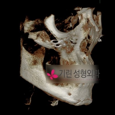 안면윤곽 후 부작용증상 1. 광대불유합 관련 이미지 1