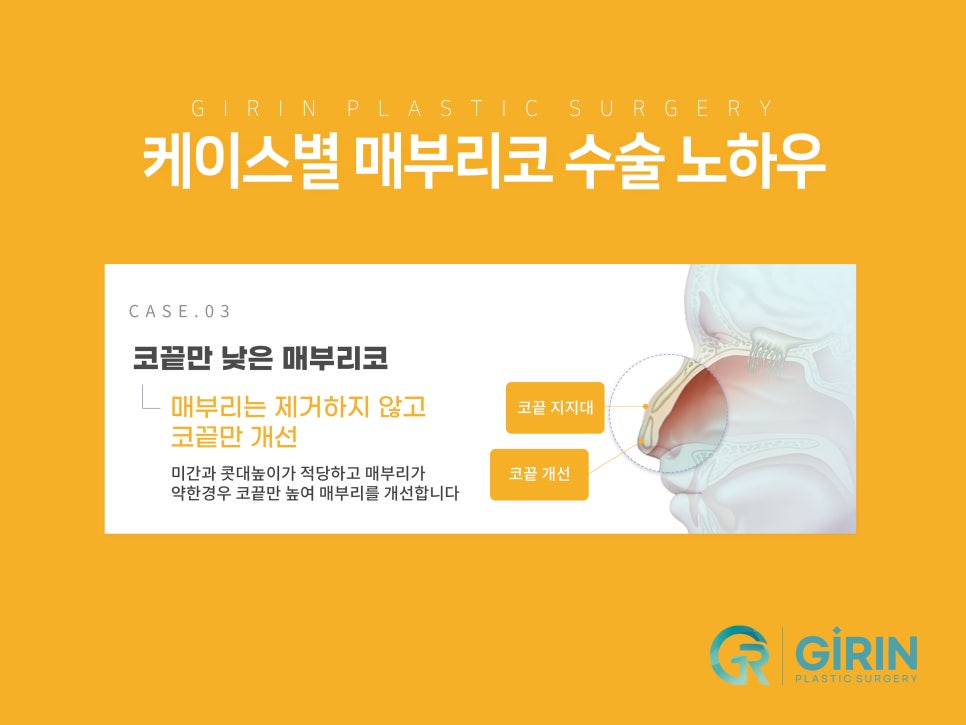 여자코성형후기 얼굴 비율까지 고려하여 관련 이미지 12