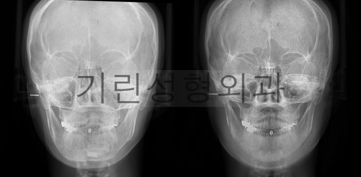 긴곡선사각턱 효과미비 재수술 관련 이미지 3