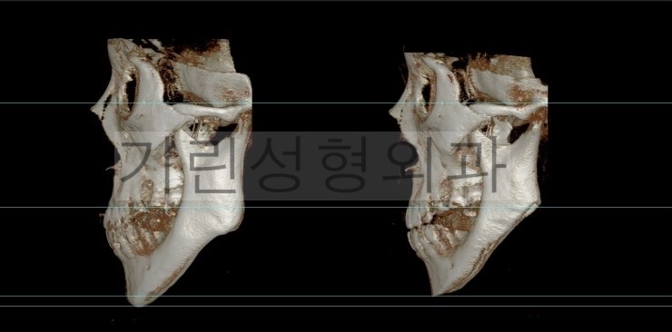 뉴브이라인 긴턱축소 사례 관련 이미지 3