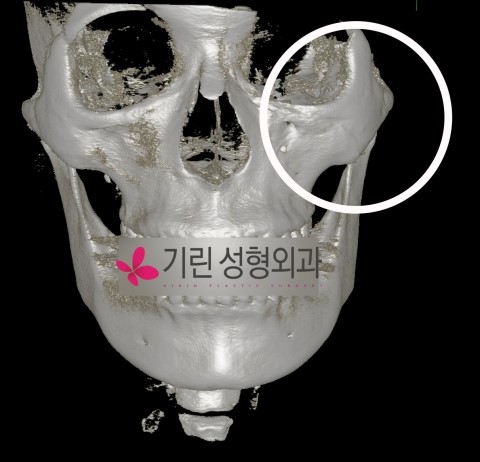 옆광대축소 전후CT 관련 이미지 3