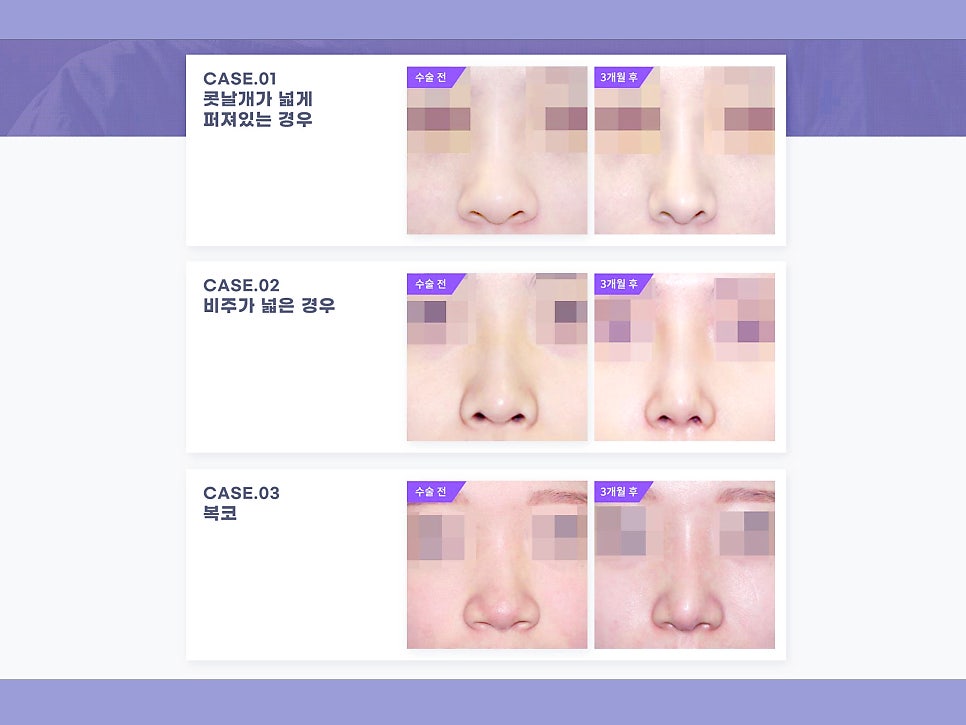 비절개콧볼축소수술 자연스럽고 예쁜 코 만들기 관련 이미지 9