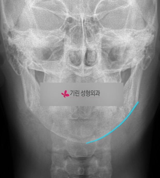 퀵안면윤곽 : 빨리 하는 수술? 붓기가 빨리 빠지는 수술? 관련 이미지 2